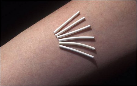 ยาคุมกำเนิดชนิดฝัง 