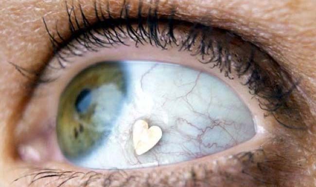 คอนแทคเลนส์