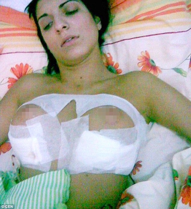 Andreea Tonciu กับทรวงอกที่ผิดรูป 