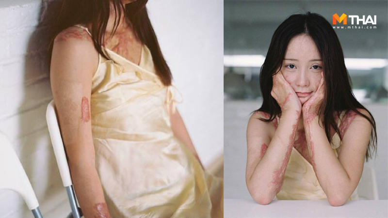 กฎหมาย กล้าหาญ การใช้ความรุนแรง ความรัก จุดไฟเผา เสียโฉม เหยื่อ แผลเป็น