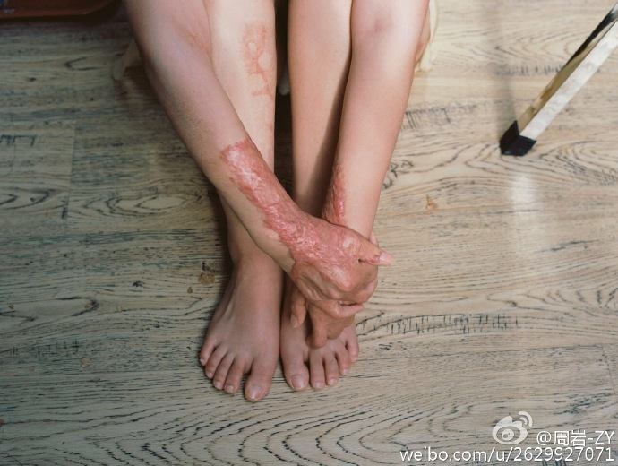 แผลเป็น