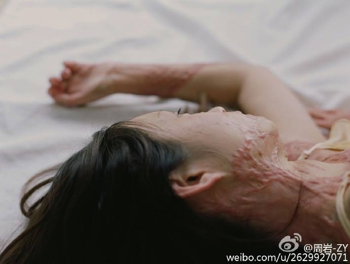 แผลเป็น