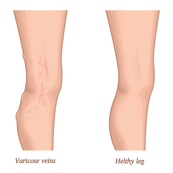 เส้นเลือดขอด