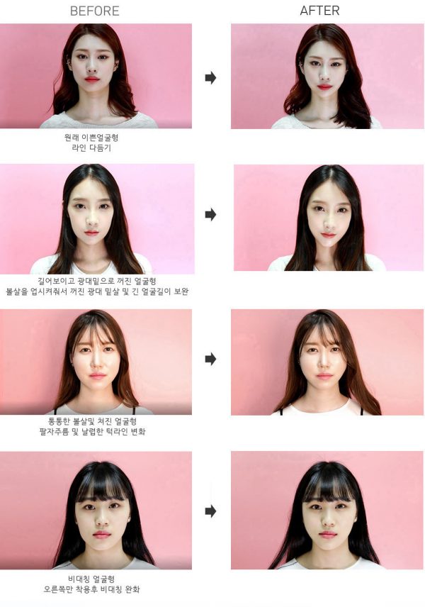 พลาสเตอร์ V-Shape