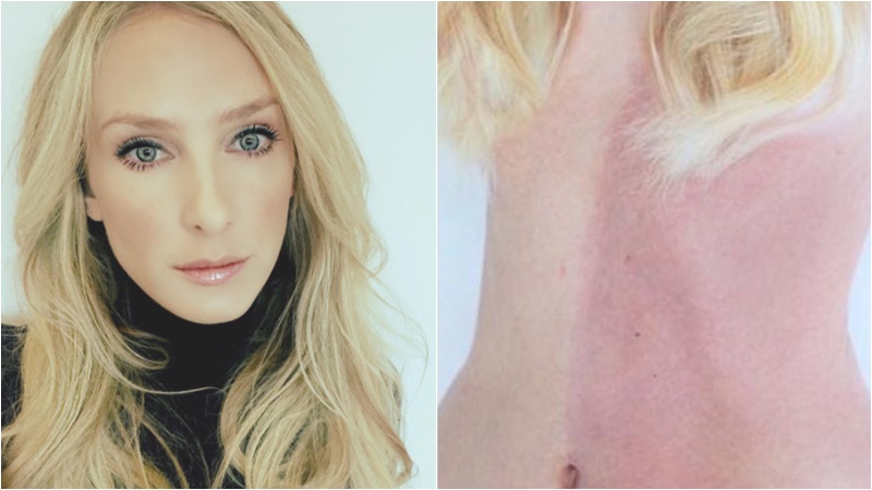 Chimerism Taylor Muhl นางแบบ สาวผิวสองสี