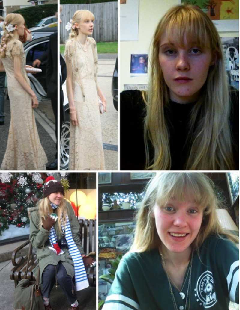 โรคคลั่งผอม