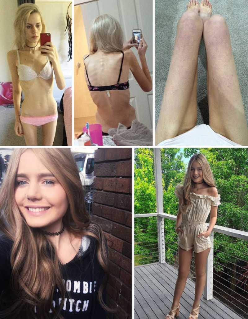 โรคคลั่งผอม