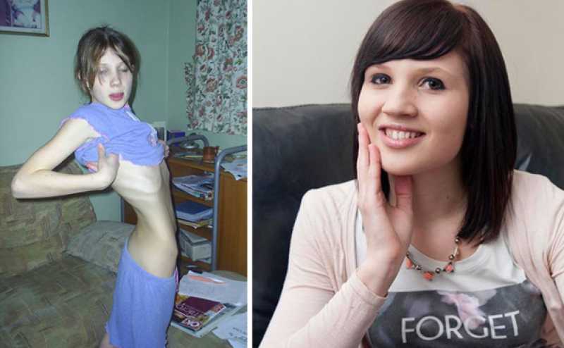 โรคคลั่งผอม