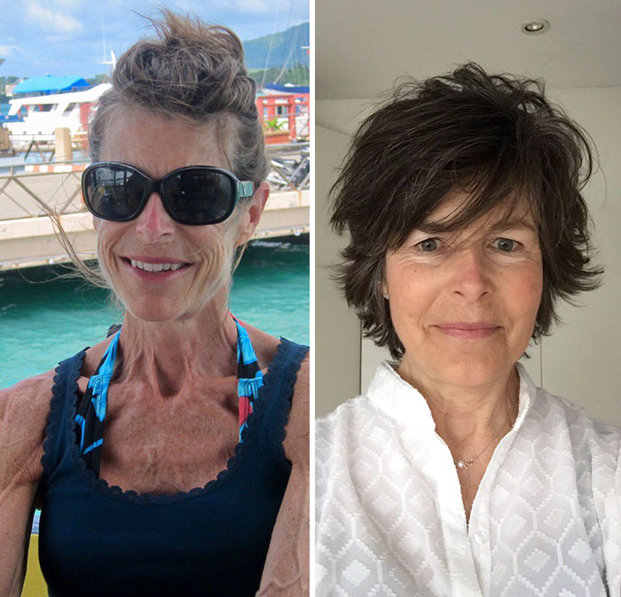 โรคคลั่งผอม