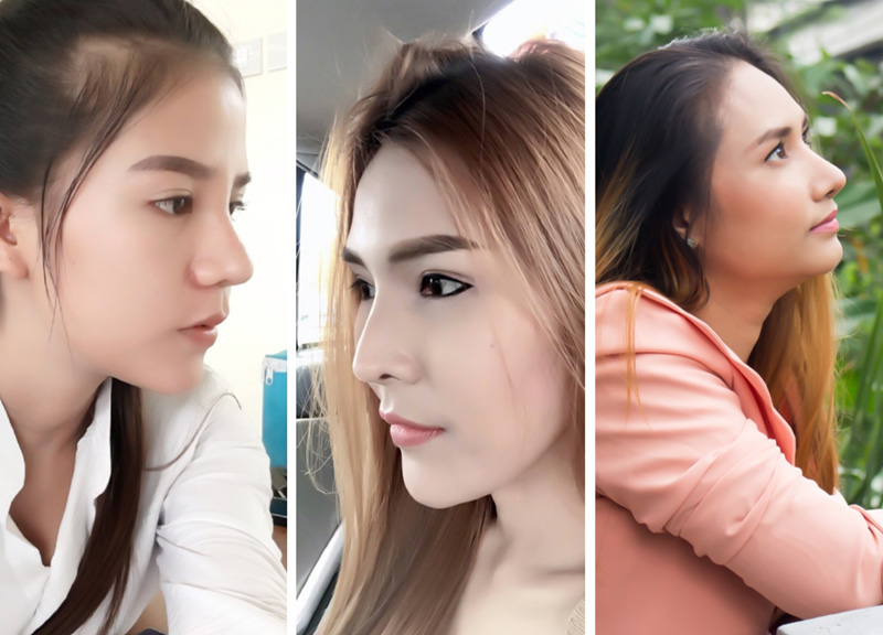 เสริมจมูก