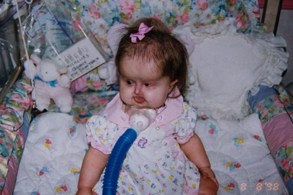 Michelle Kish โรคหายาก