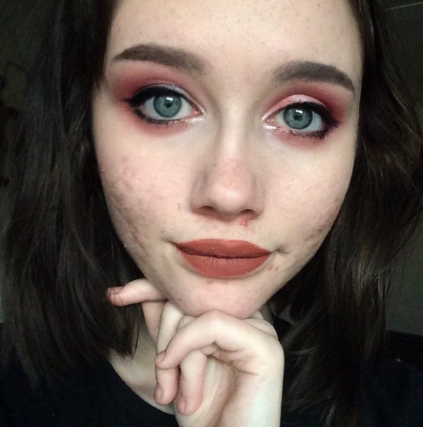 Hailey Wait หน้าสิว 