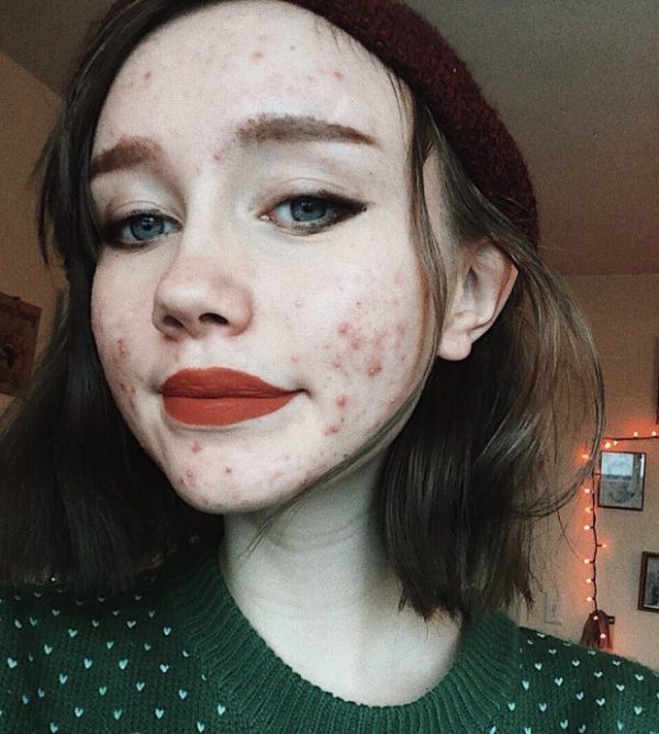 Hailey Wait หน้าสิว 