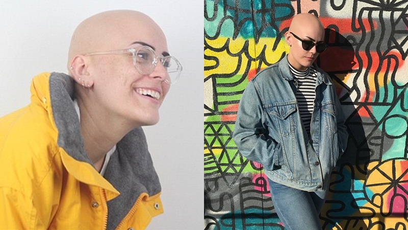 ผู้หญิงต้นแบบ ศีรษะล้าน โรคผมร่วง