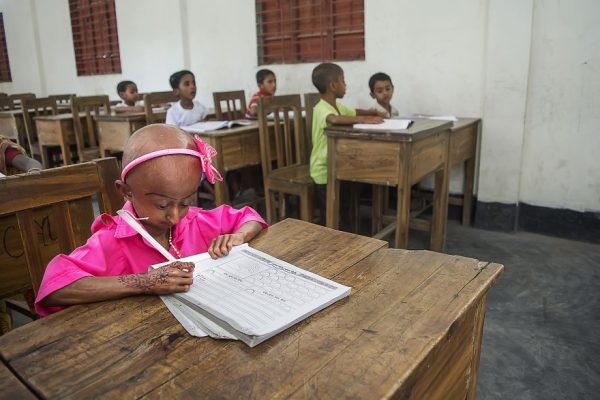 โรคชราในเด็ก