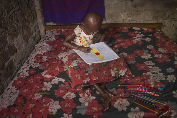 โรคชราในเด็ก