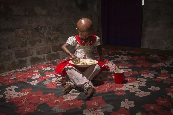 โรคชราในเด็ก