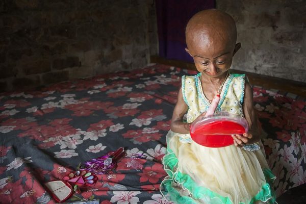 โรคชราในเด็ก