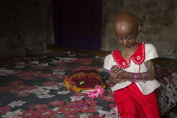 โรคชราในเด็ก