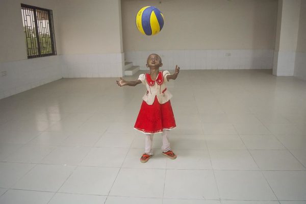 โรคชราในเด็ก