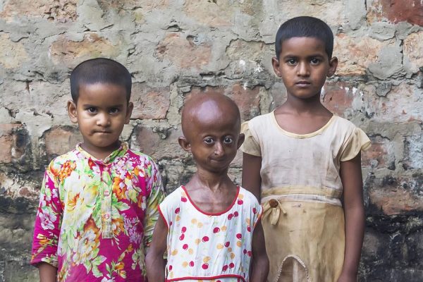 โรคชราในเด็ก