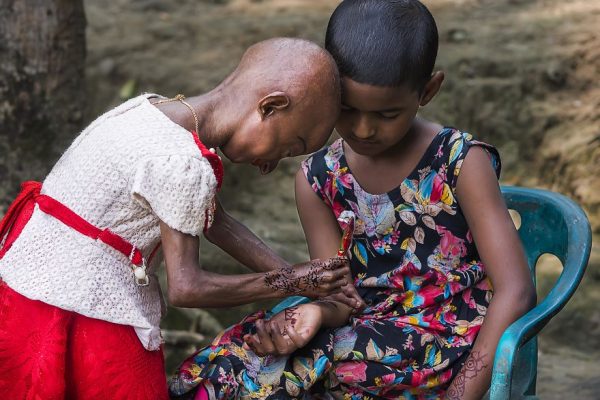 โรคชราในเด็ก