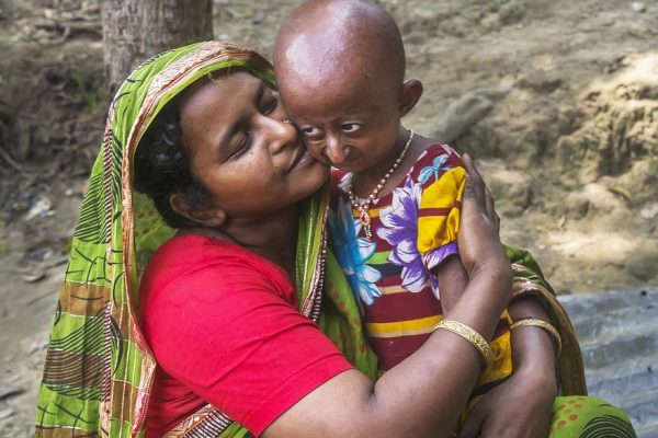 โรคชราในเด็ก