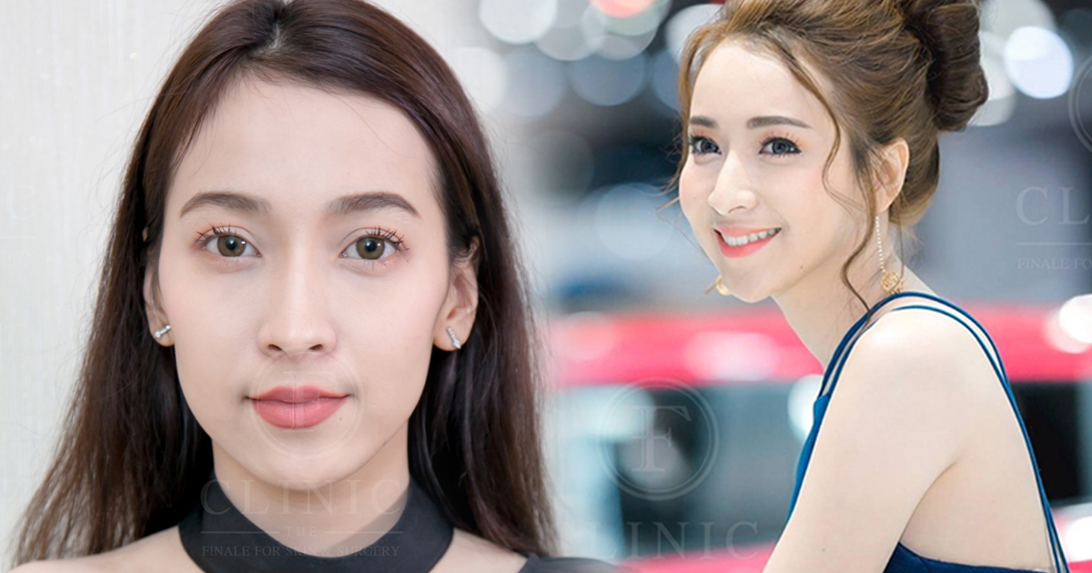 Fat Transfer FClinic