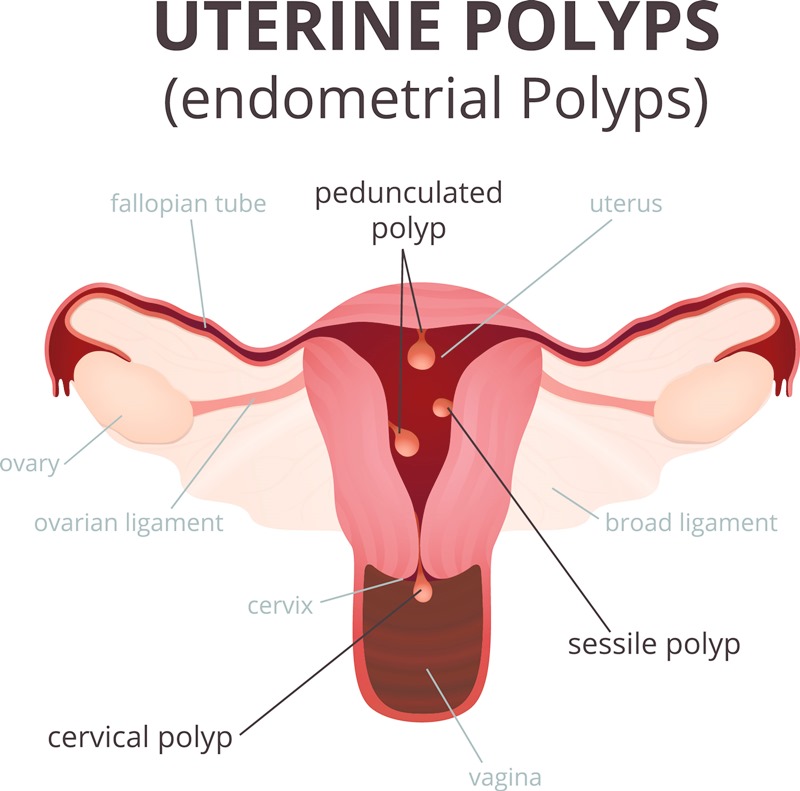 มีลูกยาก