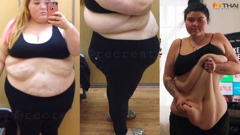 ผ่าตัดกระชับหน้าท้อง ลดความอ้วน ลดน้ำหนัก ศัลยกรรมหน้าท้อง สาวอ้วน