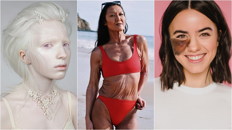 นางแบบแปลก ผู้หญิงตัวอย่าง ผู้หญิงสตรอง ผู้หญิงแกร่ง โรคหายาก