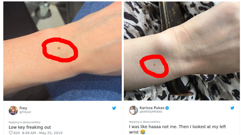 ขี้แมลงวัน จุดดำ จุดด่างดำ เป็นไฝ ไฝที่ข้อมือ