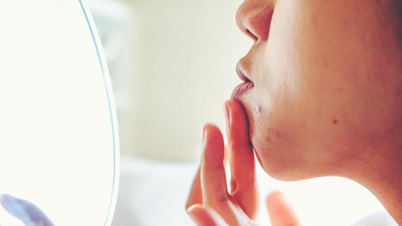 ดูแลผิว บำรุงผิว ผดขึ้น ฟื้นฟูผิว สิวขึ้น สิวเห่อ